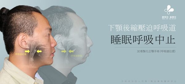 白天嗜睡患者3D客製化正顎手術前後側臉與呼吸道拓寬對比