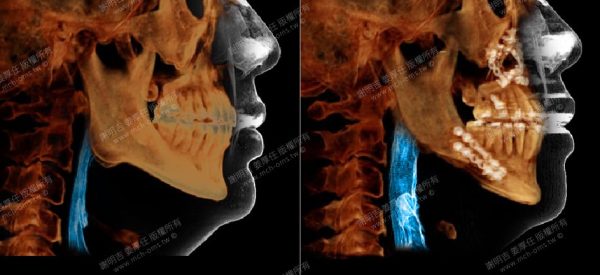 Comparison of airway CT scans before and after MMA jaw reduction surgery in a 28-year-old male.