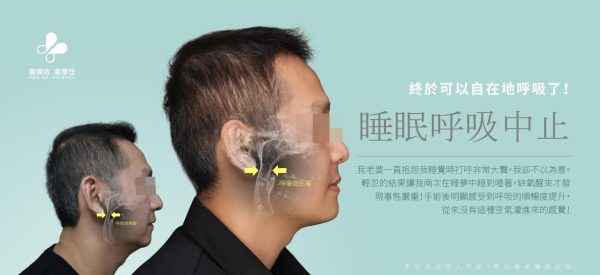 睡眠呼吸中止症患者正顎手術前後側臉與呼吸道狹隘拓寬對比