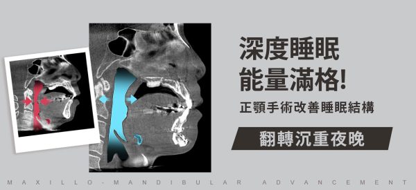 深度睡眠能量滿格！正顎手術改善睡眠結構翻轉沉重夜晚