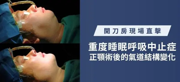 重度睡眠呼吸中止症正颚术后的气道结构变化