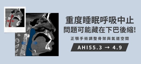 嚴重打呼白天嗜睡問題可能藏在下巴後縮