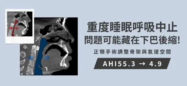 严重打呼白天嗜睡问题可能藏在下巴后缩