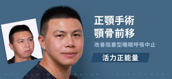 正顎手術幫助治療睡眠呼吸中止，壯男重拾生活正能量