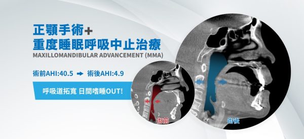 重度睡眠呼吸中止症MMA正顎手術案例主視覺，AHI由40.5降至4.9