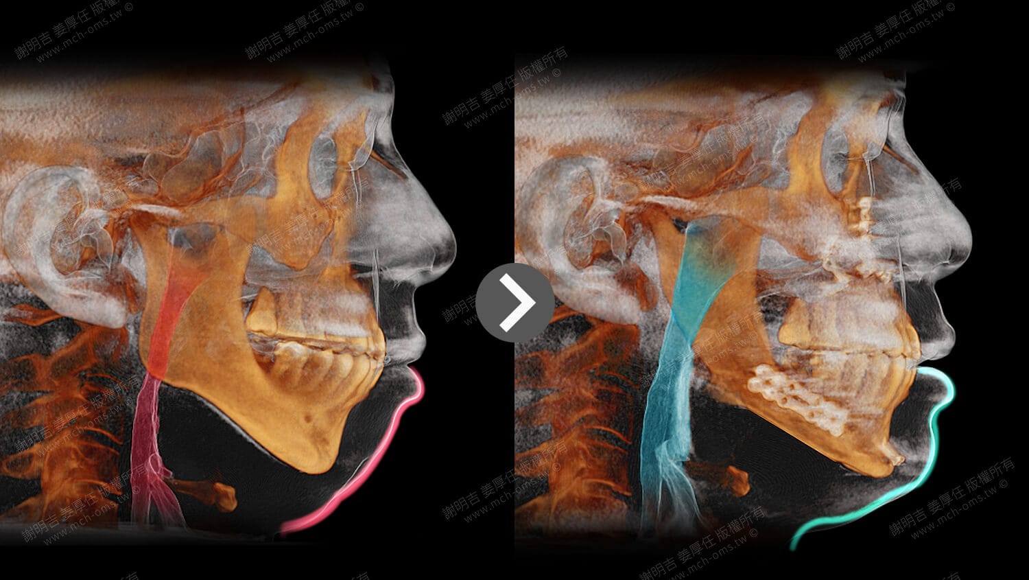 Orthognathic surgery helps treat sleep apnea, and a strong man regains positive energy in life 3 3D tomographic comparison of skeletal and soft tissue contours and airway before and after maxillary and mandibular advancement surgery.