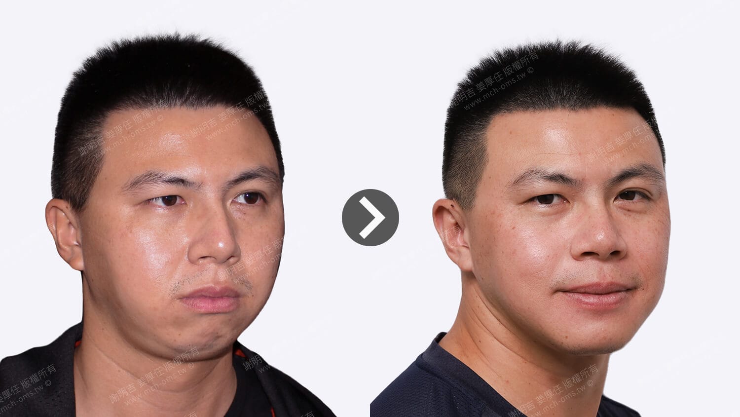 Orthognathic surgery helps treat sleep apnea, and a strong man regains positive energy in life 7 Comparison of 45-degree bevel appearance before and after orthognathic surgery