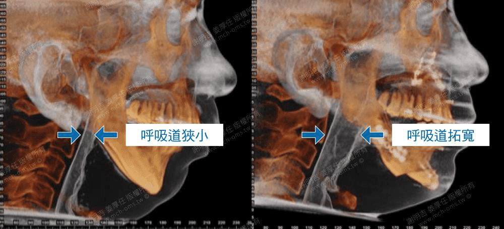 Orthognathic surgery can consider and improve multiple choke points at the same time (multilevel surgery), and can even reshape facial bones and improve your face shape.