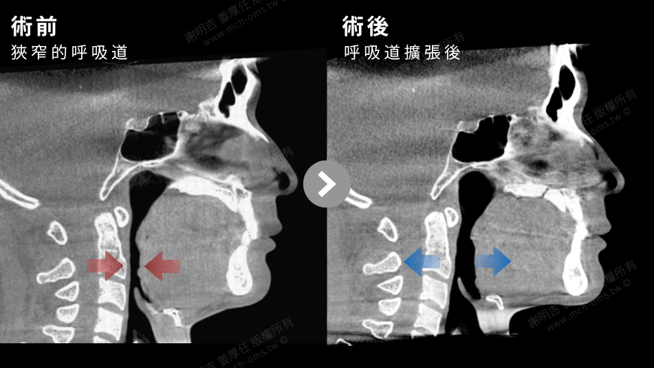低 AHI 卻伴隨嚴重症狀?以 MMA 正顎手術結合隱形矯正重建呼吸道、咬合與垂直比例 17 下顎後縮合併睡眠呼吸中止症患者MMA手術前後的呼吸道空間對比