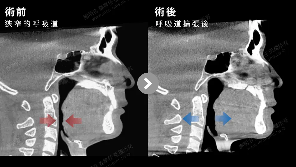 Low AHI but accompanied by severe symptoms? MMA orthognathic surgery combined with invisible braces to reconstruct the airway, occlusion, and vertical proportions (17%). Comparison of airway space before and after MMA surgery in patients with mandibular retrusion and sleep apnea