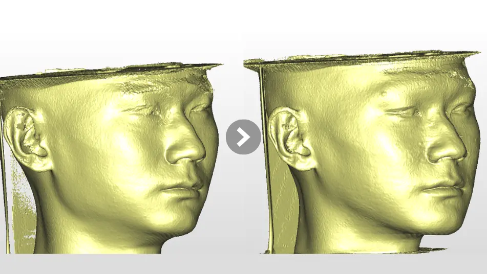 Low AHI but accompanied by severe symptoms? MMA orthognathic surgery combined with invisible braces to reconstruct the airway, bite, and vertical proportions to 18. 3D soft tissue oblique facial proportion comparison before and after MMA orthognathic surgery