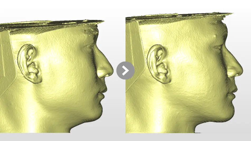 Low AHI but accompanied by severe symptoms? MMA orthognathic surgery combined with invisible braces to reconstruct the airway, occlusion, and vertical proportions. 3D soft tissue profile comparison of front and side views before and after MMA orthognathic surgery