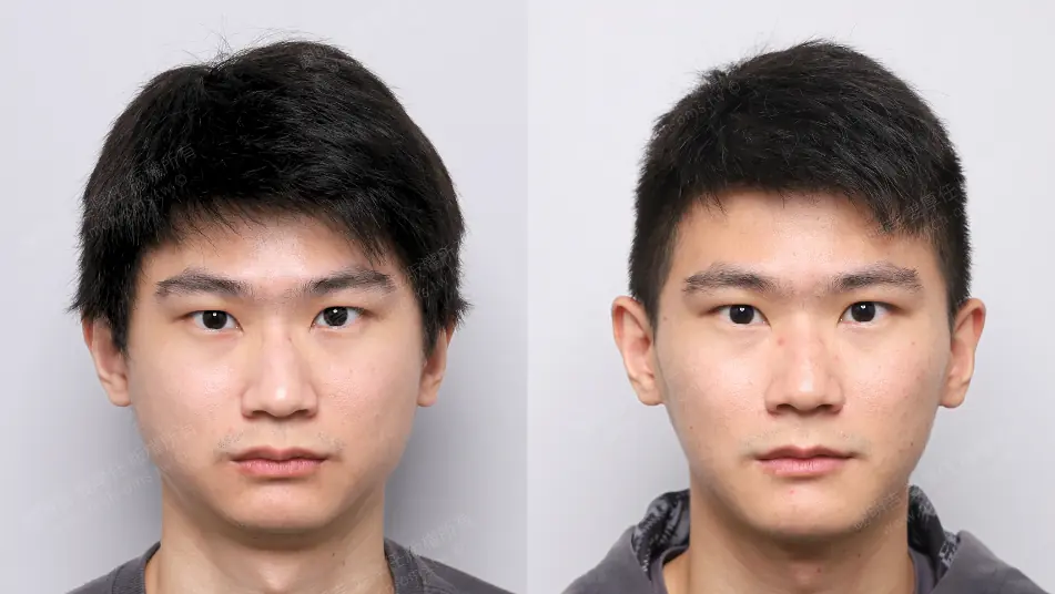 Low AHI but accompanied by severe symptoms? MMA orthognathic surgery combined with invisible braces to reconstruct the airway, occlusion, and vertical proportions. Before and after frontal appearance comparison of patients with short face syndrome undergoing MMA orthognathic surgery