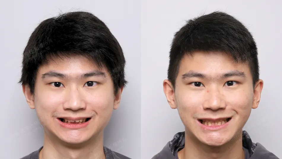 Low AHI accompanied by severe symptoms? MMA orthognathic surgery combined with invisible braces to reconstruct the airway, occlusion, and vertical proportions. Comparison of frontal smiles before and after MMA orthognathic surgery in patients with short face syndrome