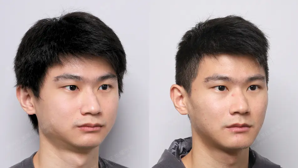 Low AHI accompanied by severe symptoms? MMA orthognathic surgery combined with invisible braces to reconstruct the airway, occlusion, and vertical proportions. Comparison of left-turn oblique profile before and after MMA orthognathic surgery