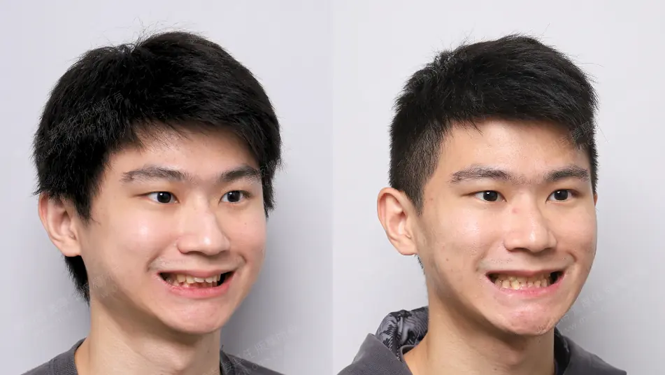 Low AHI but accompanied by severe symptoms? MMA orthognathic surgery combined with invisible braces to reconstruct the airway, occlusion, and vertical proportions. Before and after MMA orthognathic surgery, left-turning oblique smile comparison