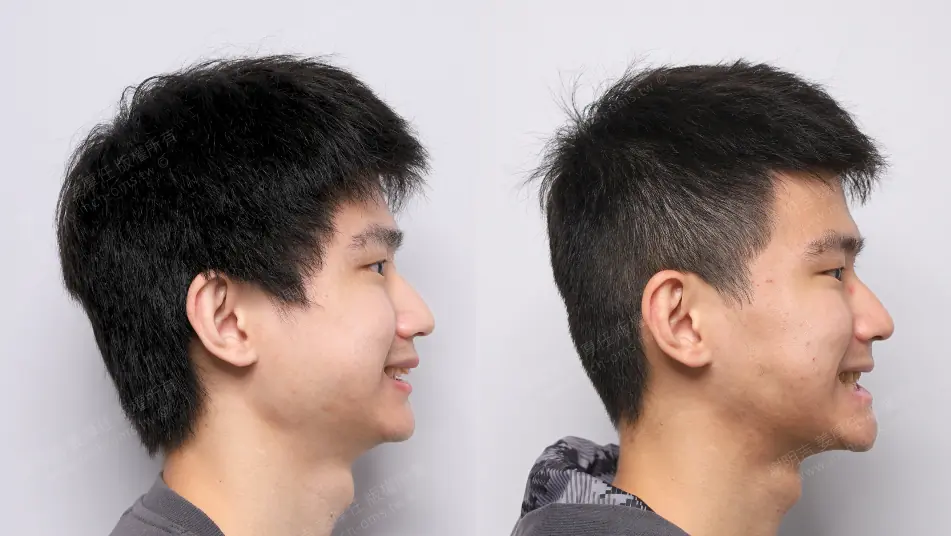 Low AHI but accompanied by severe symptoms? MMA orthognathic surgery combined with invisible braces to reconstruct the airway, occlusion, and vertical proportions. Right-side smile comparison before and after MMA orthognathic surgery