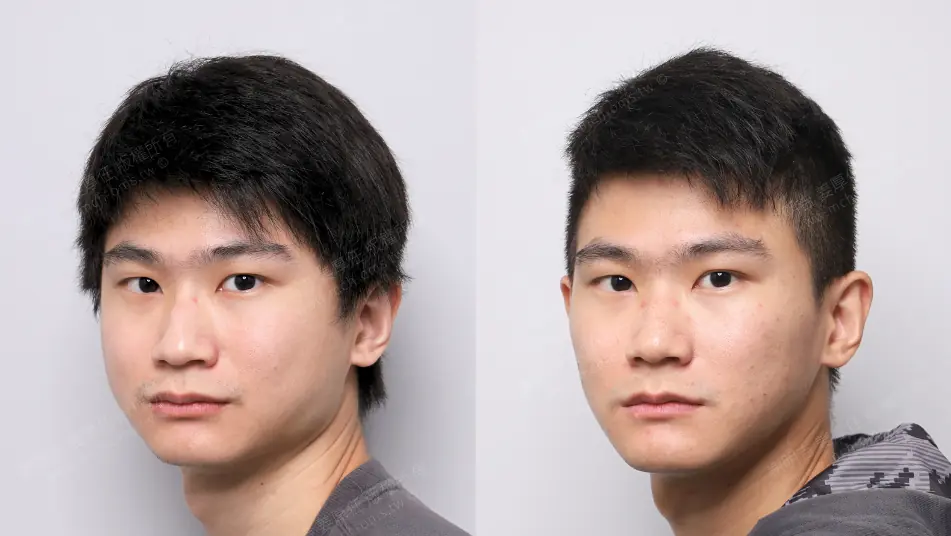 Low AHI but accompanied by severe symptoms? MMA orthognathic surgery combined with invisible braces to reconstruct the airway, occlusion, and vertical proportions. 9 Before and after MMA orthognathic surgery, comparison of appearance when turning right and looking back.