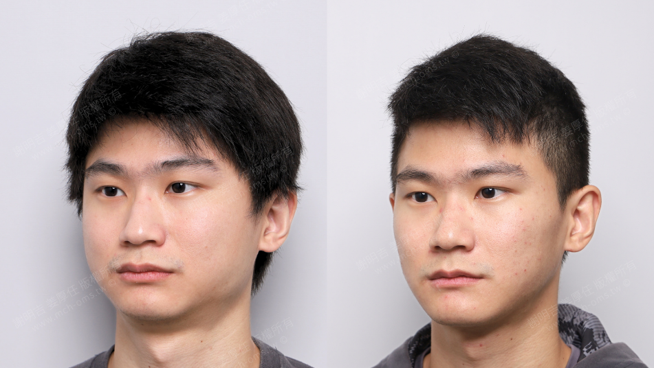 低 AHI 卻伴隨嚴重症狀?以 MMA 正顎手術結合隱形矯正重建呼吸道、咬合與垂直比例 11 MMA正顎手術前後的右轉斜側面外觀對比