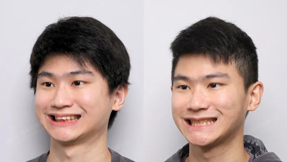 Low AHI but accompanied by severe symptoms? MMA orthognathic surgery combined with invisible braces to reconstruct the airway, bite, and vertical proportions (12). Comparison of right-turned oblique smile before and after MMA orthognathic surgery