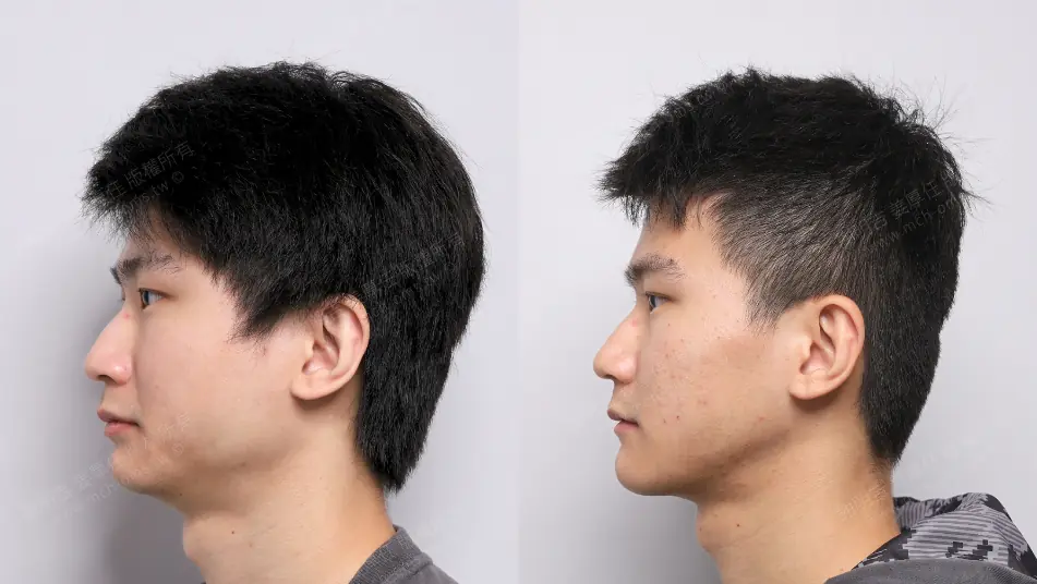 Low AHI but accompanied by severe symptoms? MMA orthognathic surgery combined with invisible braces to reconstruct the airway, occlusion, and vertical proportions. Left side appearance comparison before and after MMA orthognathic surgery