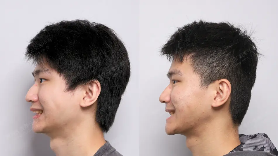 Low AHI but accompanied by severe symptoms? MMA orthognathic surgery combined with invisible braces to reconstruct the airway, occlusion, and vertical proportions. Left smile comparison before and after MMA orthognathic surgery