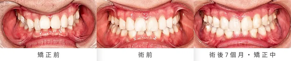 Low AHI but accompanied by severe symptoms? MMA orthognathic surgery combined with invisible braces to reconstruct the airway, occlusion, and vertical proportions by 20%. The changes in frontal bite resulting from MMA orthognathic surgery combined with invisible braces are divided into pre-treatment, pre-operative, and 7-month post-operative stages.