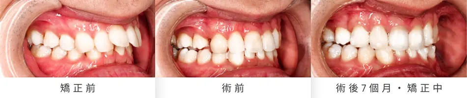 Low AHI but accompanied by severe symptoms? MMA orthognathic surgery combined with invisible braces to reconstruct the airway, occlusion, and vertical proportions. MMA orthognathic surgery combined with invisible braces results in changes to the lateral bite, divided into pre-treatment, pre-operative, and 7-month post-operative stages.