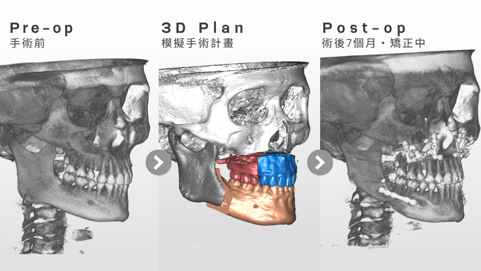 低 AHI 卻伴隨嚴重症狀?以 MMA 正顎手術結合隱形矯正重建呼吸道、咬合與垂直比例 15 MMA正顎手術的斜側面術前CT、3D手術計畫與術後顎骨對比