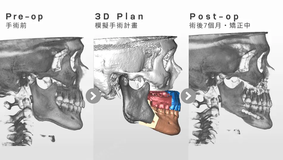 Low AHI but accompanied by severe symptoms? MMA orthognathic surgery combined with invisible braces to reconstruct the airway, bite, and vertical proportions (16). Preoperative CT scan, 3D surgical plan, and postoperative jawbone comparison of the right side during MMA orthognathic surgery.