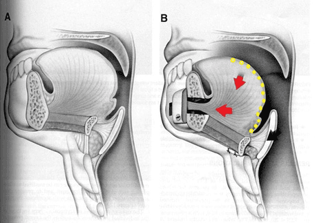 TONGUE BASE REPOSITIONING tightens the tongue muscles forward so that the patient's tongue base will not fall back when sleeping.