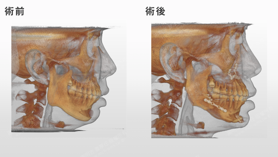 嚴重打呼、白天嗜睡?問題可能藏在下巴後縮! 1 下顎後縮患者正顎手術前後的3D骨骼CT對比