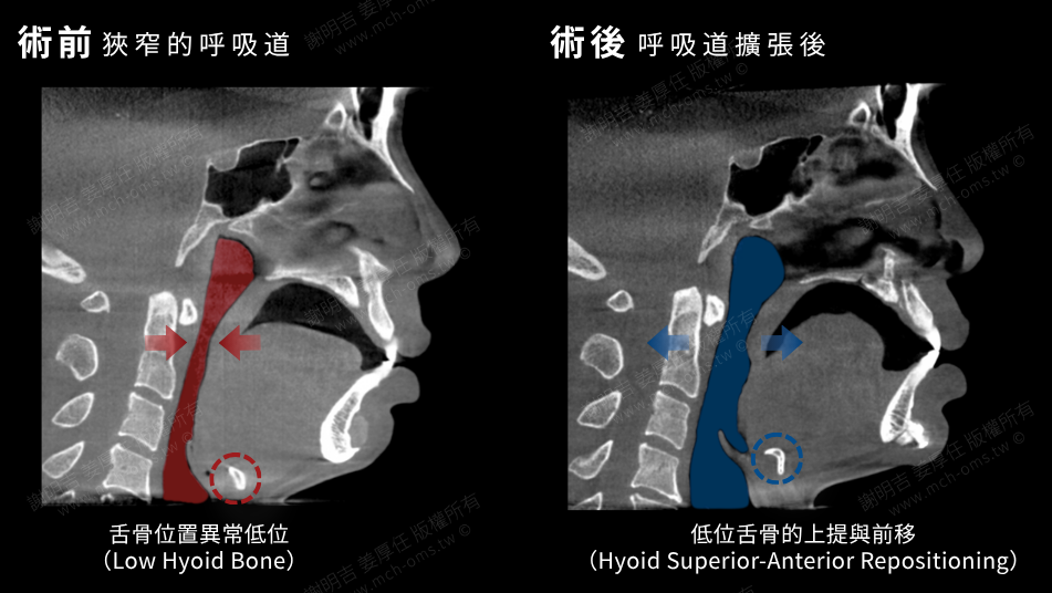 嚴重打呼、白天嗜睡?問題可能藏在下巴後縮! 3 下顎後縮患者正顎手術前後的呼吸道與舌骨位置對比