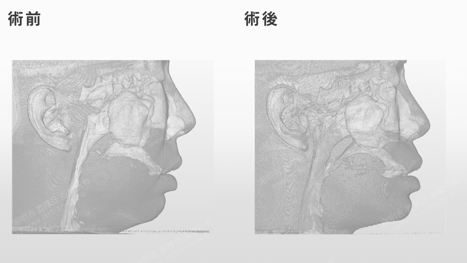 嚴重打呼、白天嗜睡?問題可能藏在下巴後縮! 2 下顎後縮患者正顎手術前後的軟組織側貌對比