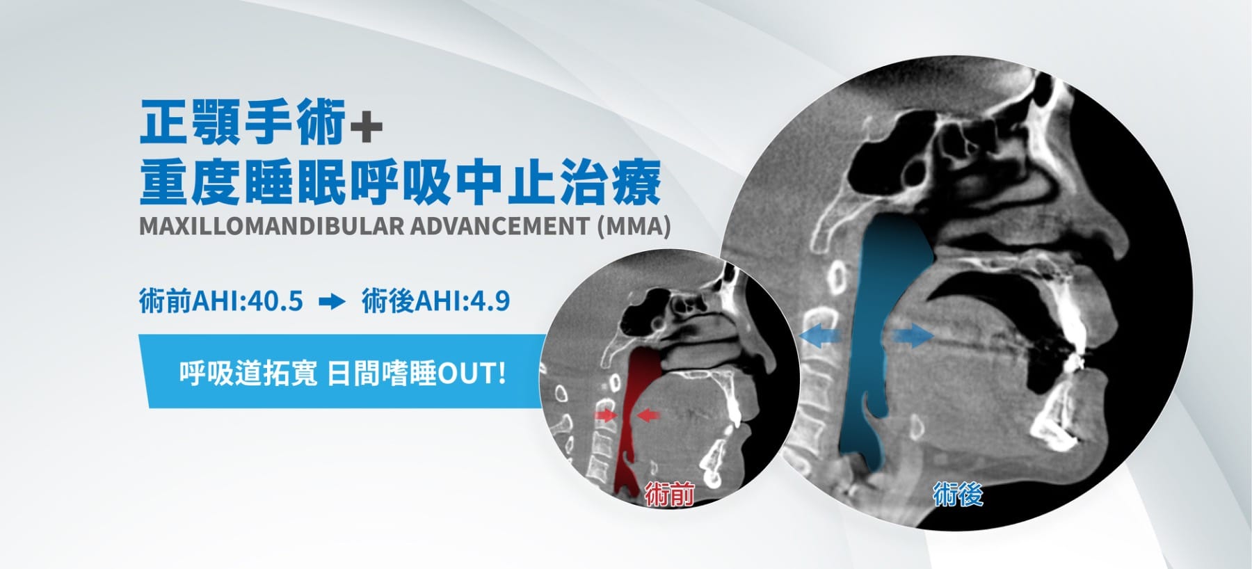 重度睡眠呼吸中止症MMA正顎手術案例主視覺，AHI由40.5降至4.9