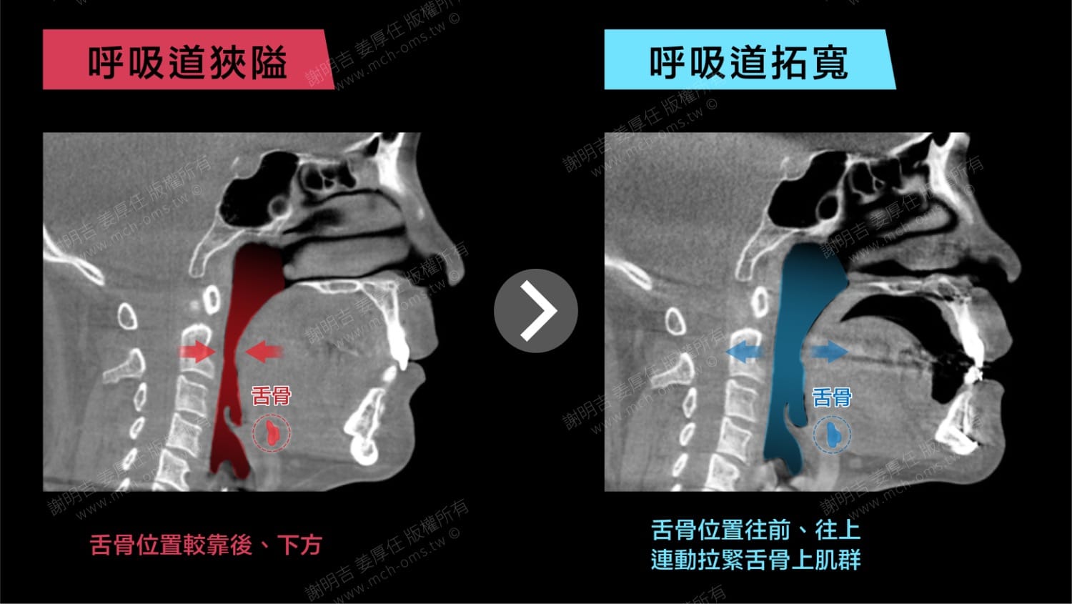 重度睡眠呼吸中止症患者正顎手術前後呼吸道斷層對比，舌骨往前上移動