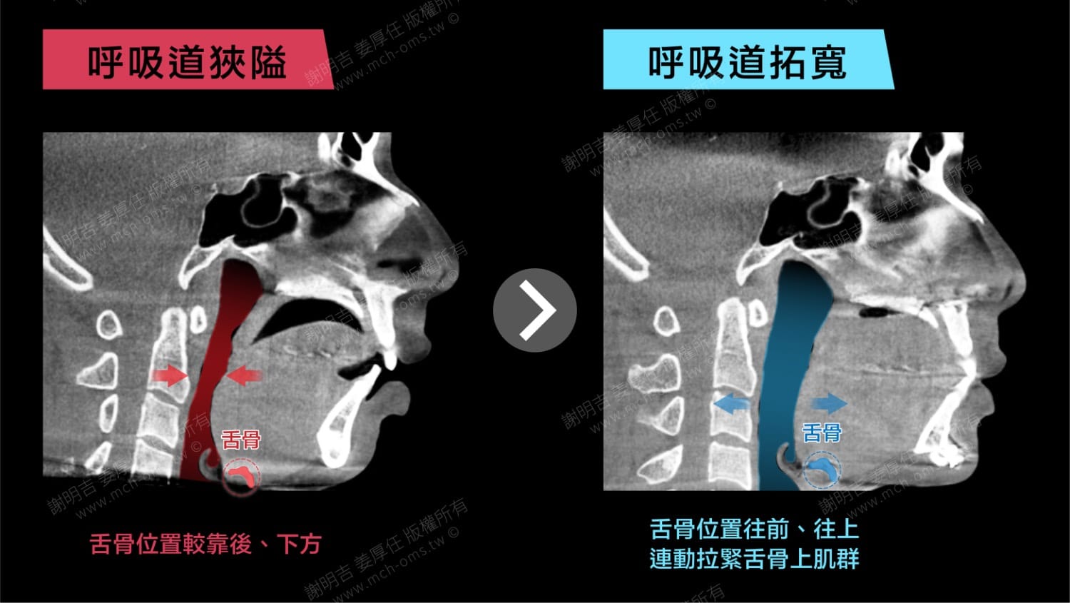 逆時針雙顎前移手術:拓寬氣道、改善中度睡眠呼吸中止症 1 雙顎前移手術前後呼吸道斷層對比,術後舌骨往前上移動、呼吸道拓寬