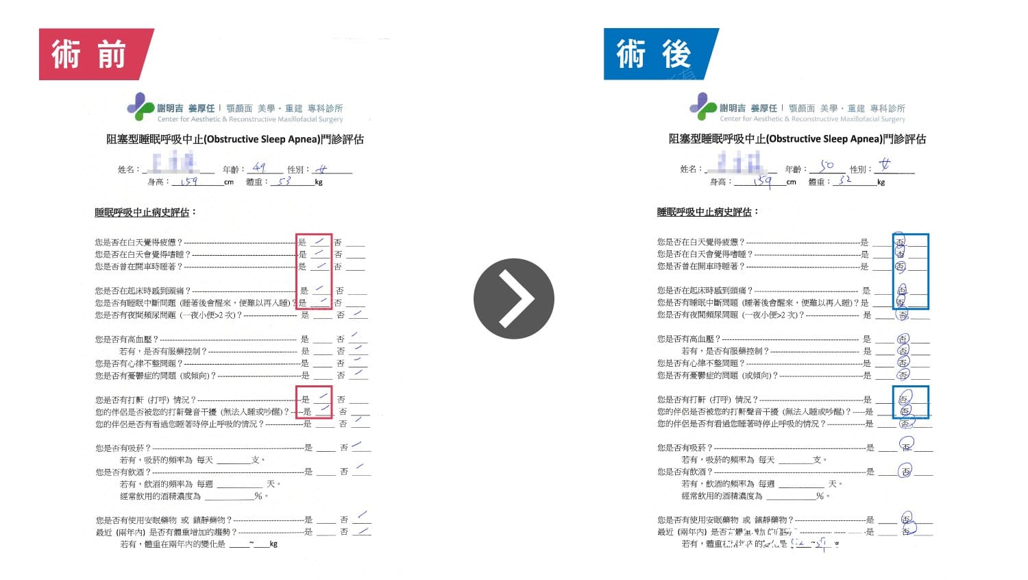 阻塞型睡眠呼吸中止門診評估表術前術後對比，白天疲憊與打鼾等項目由「是」轉為「否」