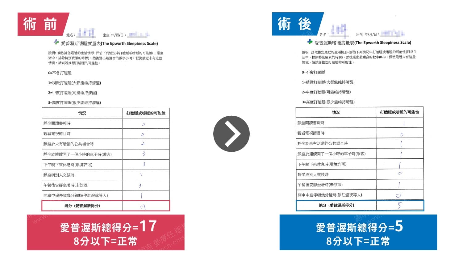 重度睡眠呼吸中止症患者愛普渥斯嗜睡量表術前術後對比，總得分由17降至5