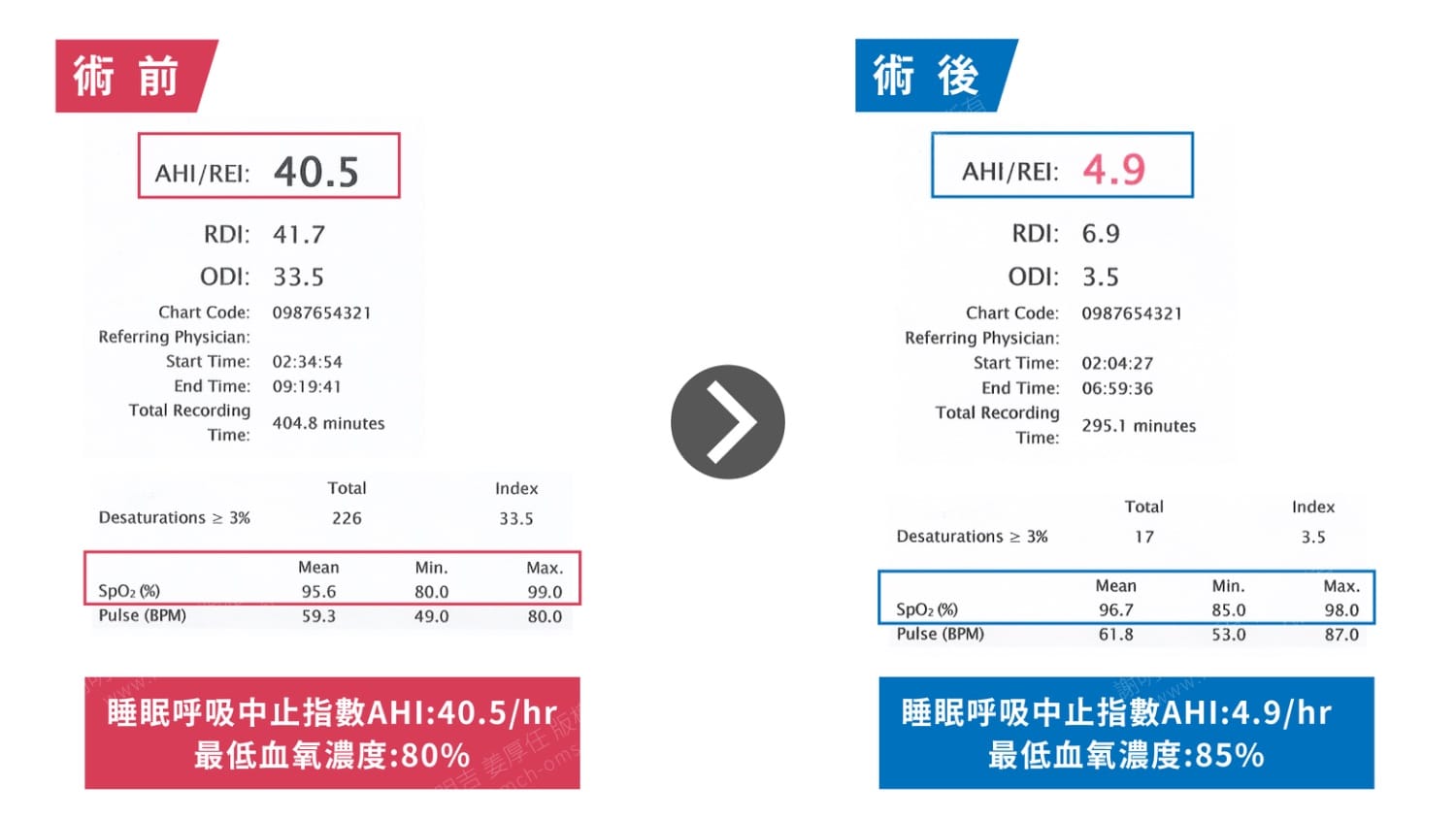 術前術後睡眠檢測報告對比，AHI由40.5降至4.9、最低血氧由80%提升至85%