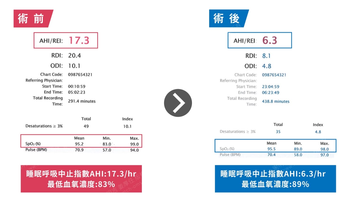 逆時針雙顎前移手術:拓寬氣道、改善中度睡眠呼吸中止症 2 術前術後睡眠檢測報告對比,AHI由17.3降至6.3、最低血氧由83%提升至89%