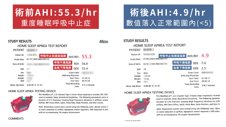 嚴重打呼、白天嗜睡?問題可能藏在下巴後縮! 4 正顎手術前後睡眠檢測報告與AHI變化對比